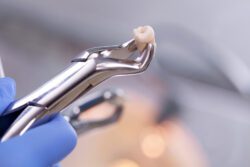 At Loyalsock Dental Associates in Williamsport, PA, we understand that tooth extraction, particularly of wisdom teeth, can cause anxiety.